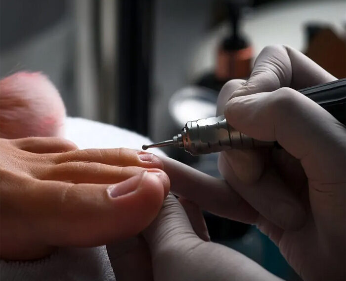 MESOTERAPIA SIN AGUJAS EN LOS PIES