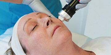 RADIOFRECUENCIA FRACCIONADA