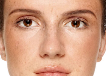 Hiperpigmentación, una consecuencia del exceso de melanina