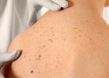 Desarrollo de manchas hipercrómicas y acrómicas