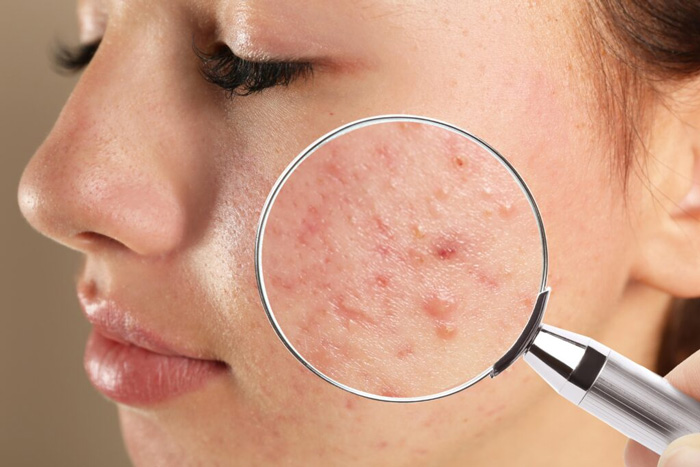 ACNE VULGAR