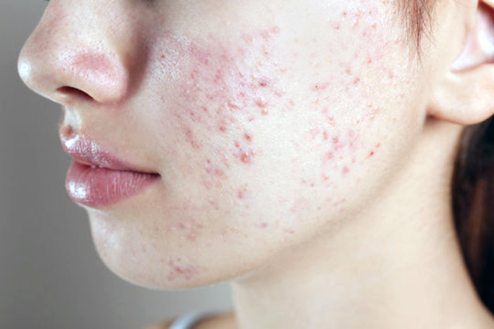ACNE VULGAR