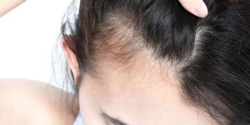 ALOPECIA TELOGENA