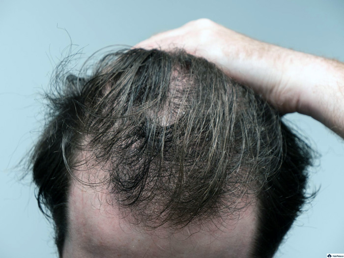 ALOPECIA TELOGENA