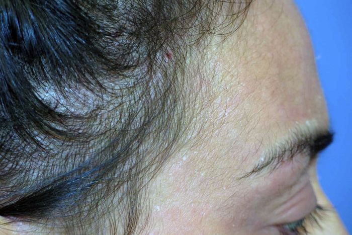 ALOPECIA TELOGENA