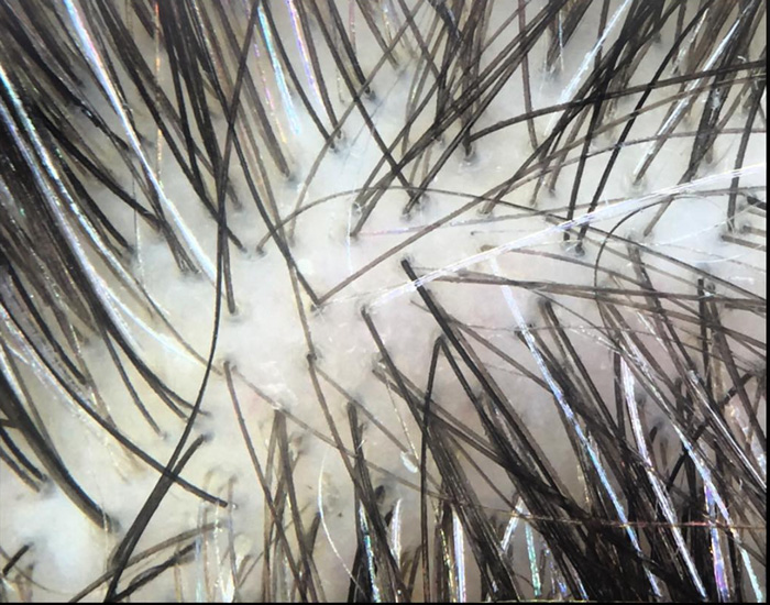 ALOPECIA TELOGENA