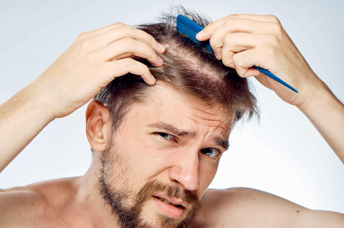 ALOPECIA TELOGENA