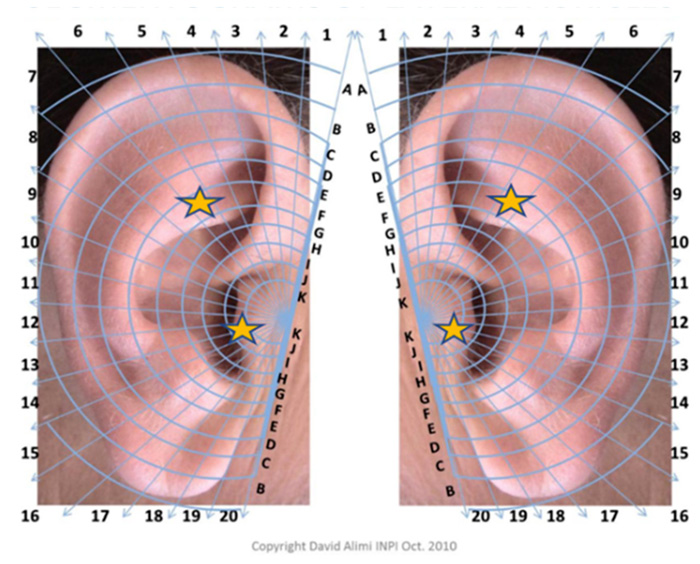 Auriculoterapia