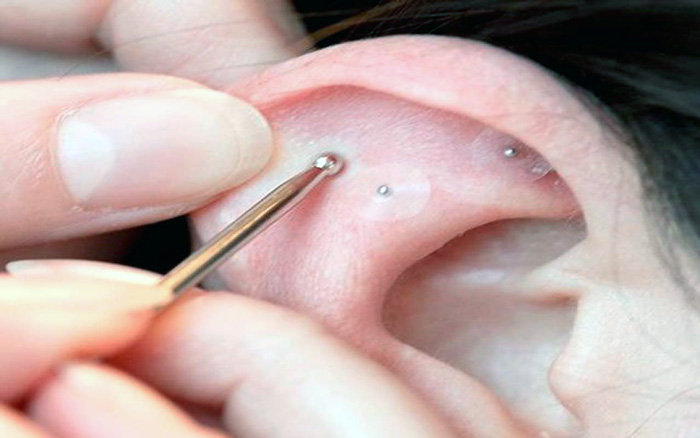 Auriculoterapia