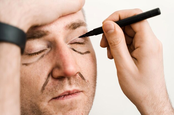 BLEFAROPLASTIA
