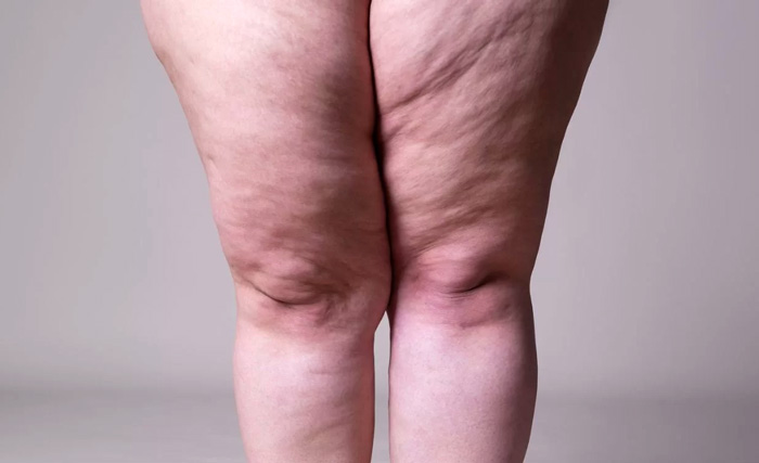 CELULITIS