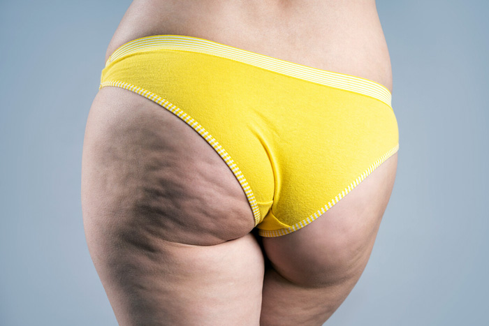 CELULITIS