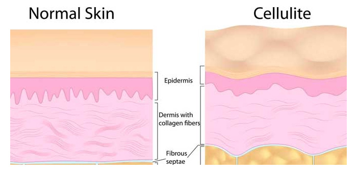 CELULITIS