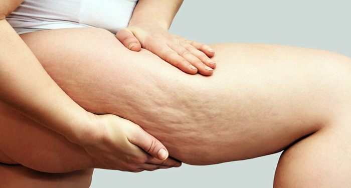 CELULITIS