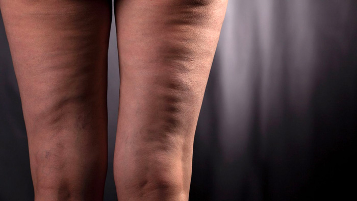 CELULITIS