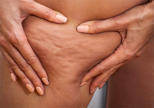 CELULITIS