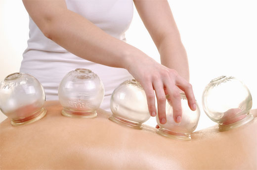 CUPPING