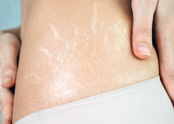 Estrías, un problema de difícil resolución