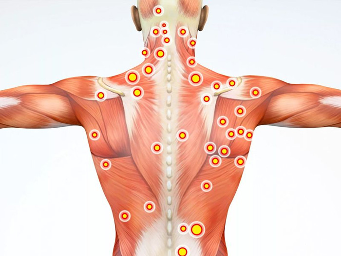 Síndrome de Dolor Miofascial y puntos gatillo