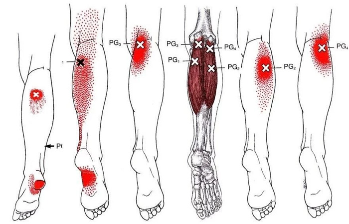 Síndrome de Dolor Miofascial y puntos gatillo