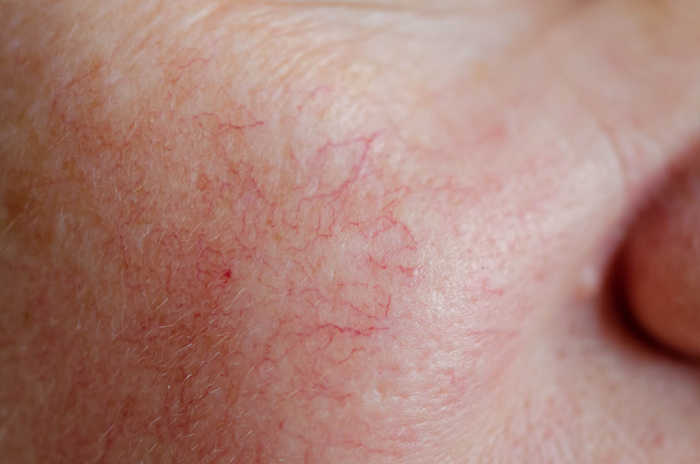 Telangiectasias faciales