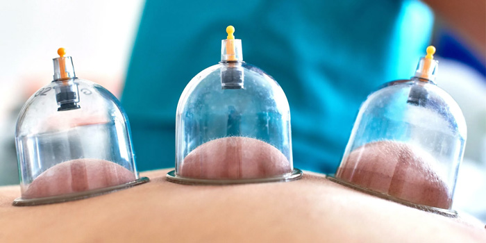 CUPPING