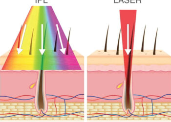 Depilación IPL: ventajas y desventajas de la luz pulsada intensa