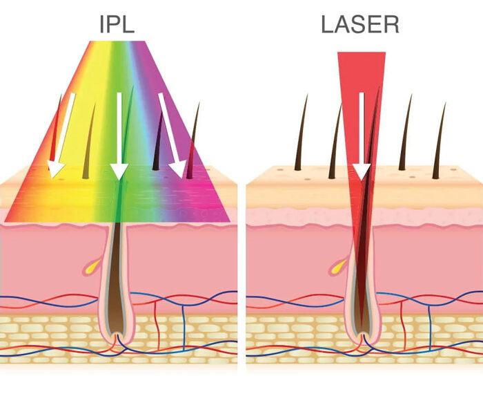 Depilación IPL: ventajas y desventajas de la luz pulsada intensa