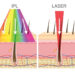 Depilación IPL: ventajas y desventajas de la luz pulsada intensa