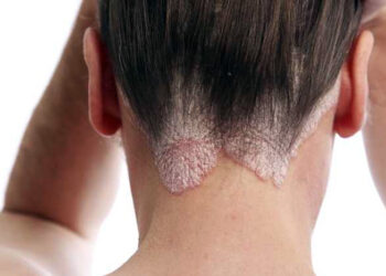 DERMATITIS SEBORREICA