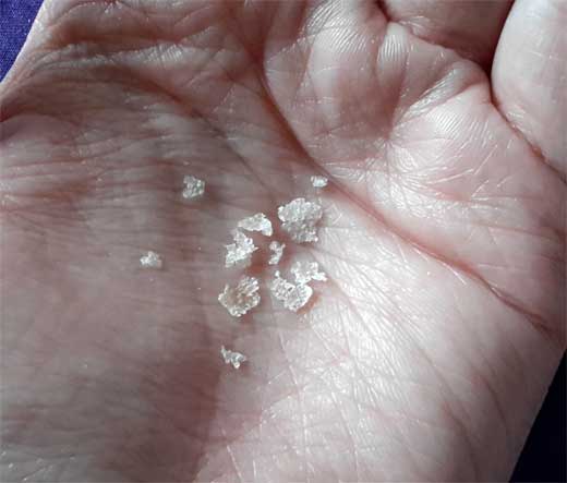 DERMATITIS SEBORREICA