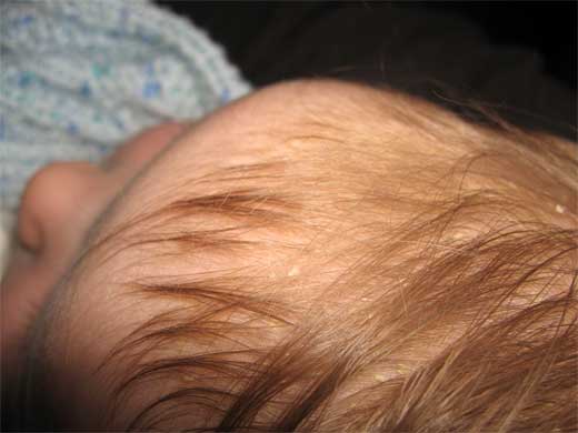 DERMATITIS SEBORREICA