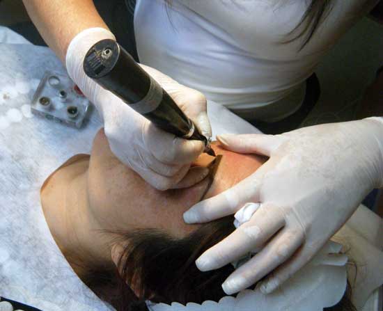 DERMOPIGMENTACION