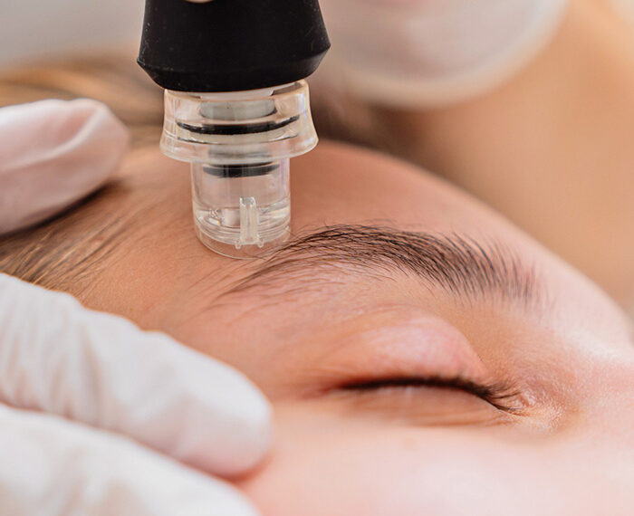 Microdermoabrasión, una combinación de exfoliación, leve succión y compresión