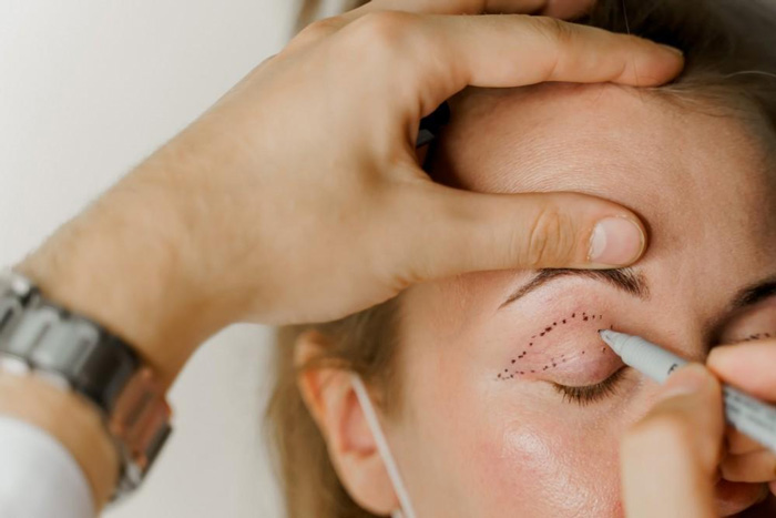BLEFAROPLASTIA