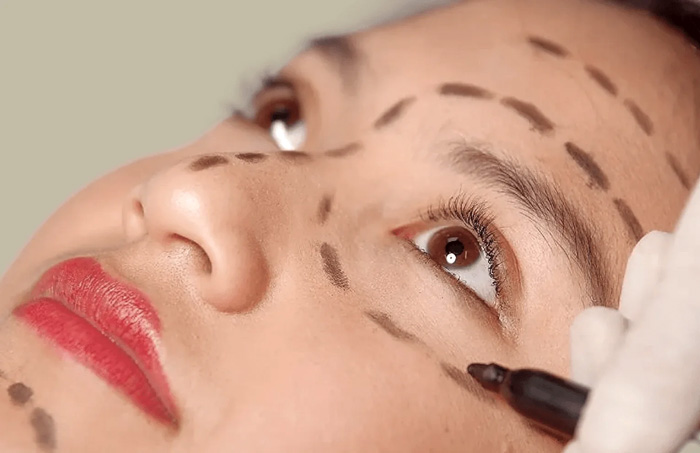 BLEFAROPLASTIA