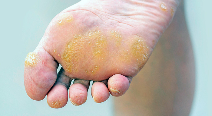 HIPERQUERATOSIS