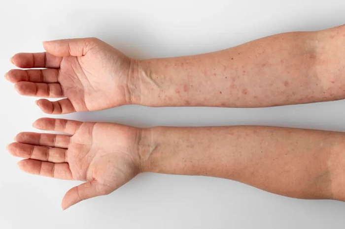 HIPERQUERATOSIS