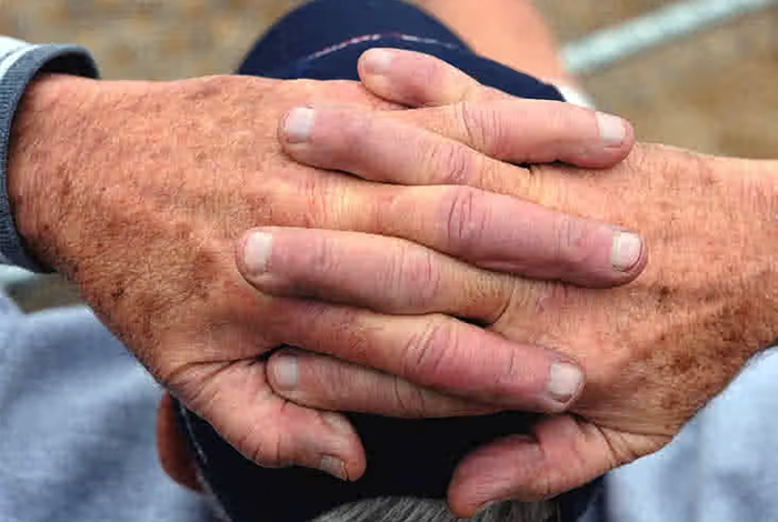 HIPERQUERATOSIS