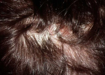 HONGOS EN EL CABELLO