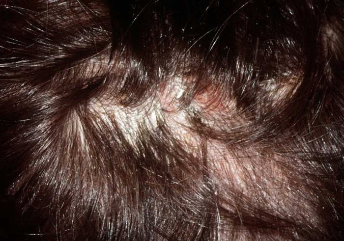 HONGOS EN EL CABELLO