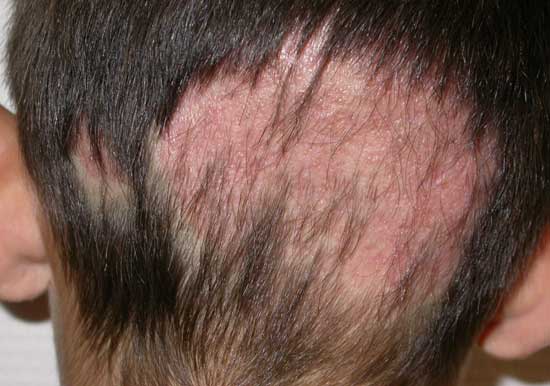 HONGOS EN EL CABELLO