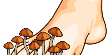 HONGOS EN LOS PIES