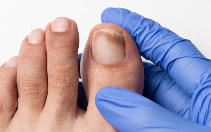 HONGOS EN LOS PIES