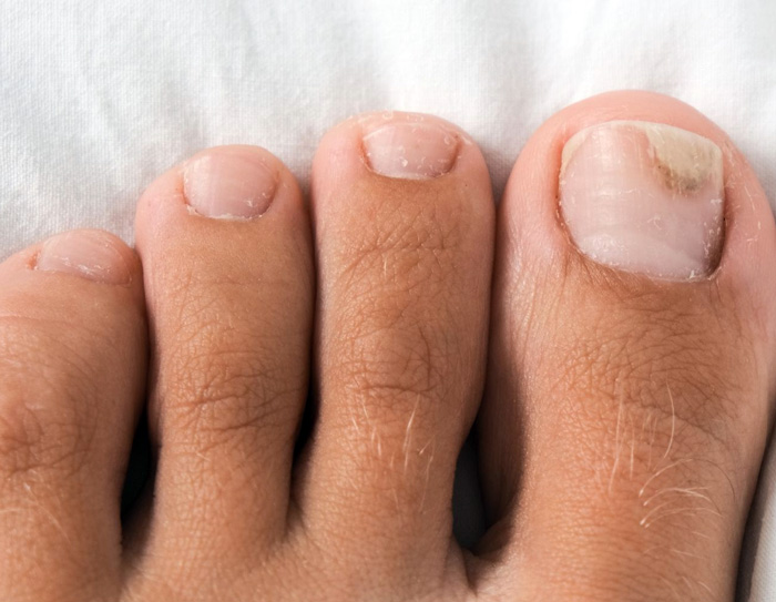 Hongos y micosis: en verano no hay más contagio