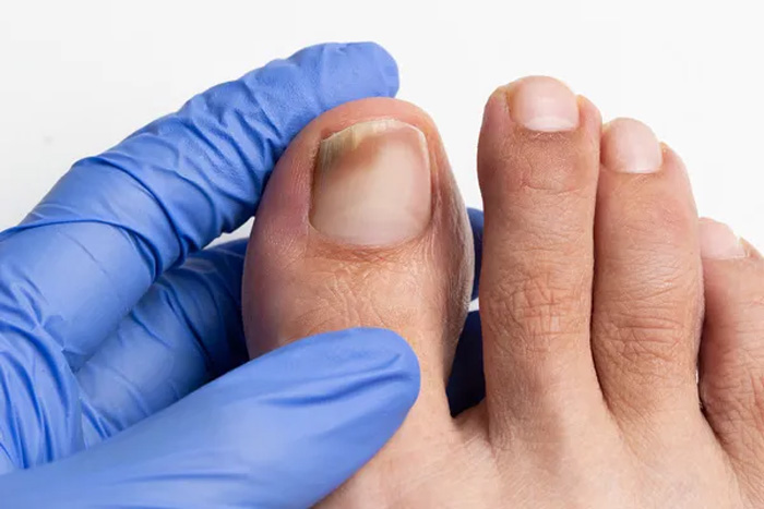Hongos y micosis: en verano no hay más contagio