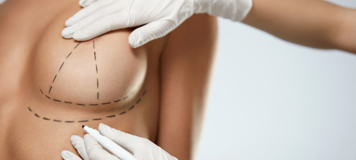 Implantes mamarios de gel de silicona: información de seguridad