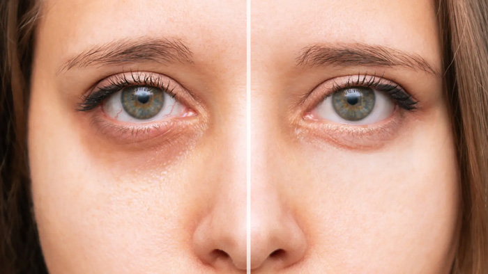 OJERAS