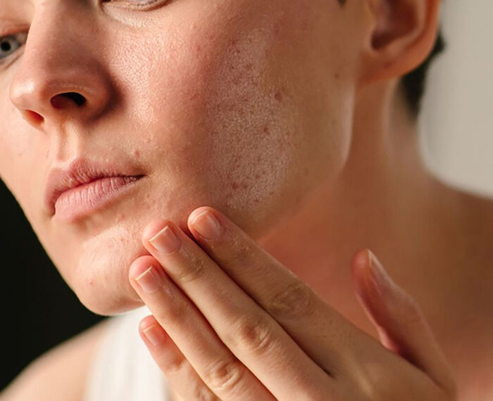 Acné después de los 40 años