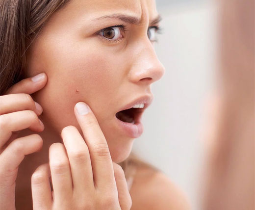 ACNE COSMETICO